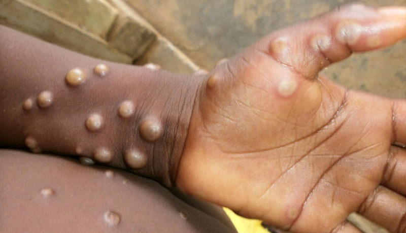 monkeypox