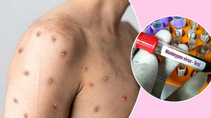 Monkeypox Virus News