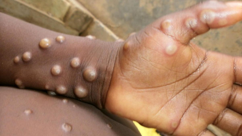 MonkeyPox