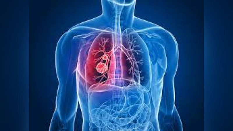 World Lung Cancer Day Special 90 percent of lung cancers caused by smoking
