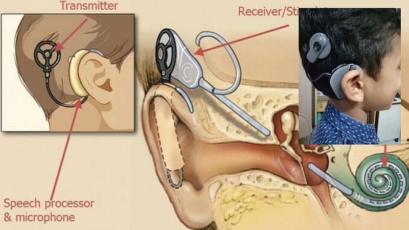 Nagpur Cochlear Implants ear surgery