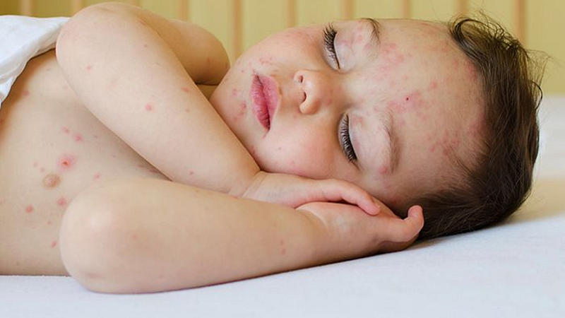 Monkeypox