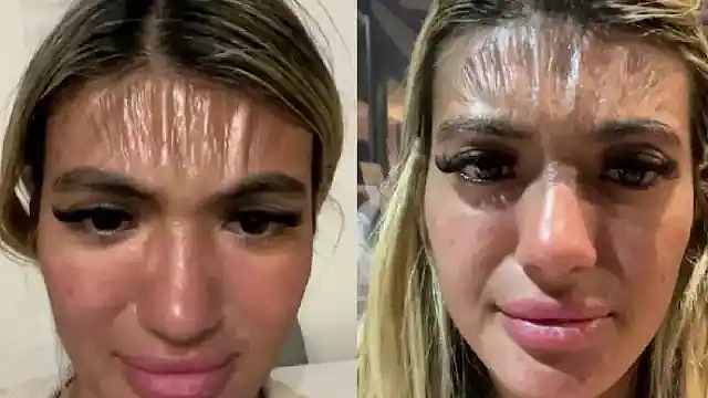 plastic skin at forehead woman