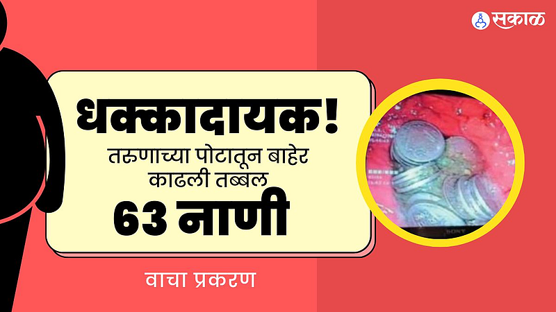 धक्कादायक! तरुणाच्या पोटातून बाहेर काढली तब्बल 63 नाणी, वाचा प्रकरण