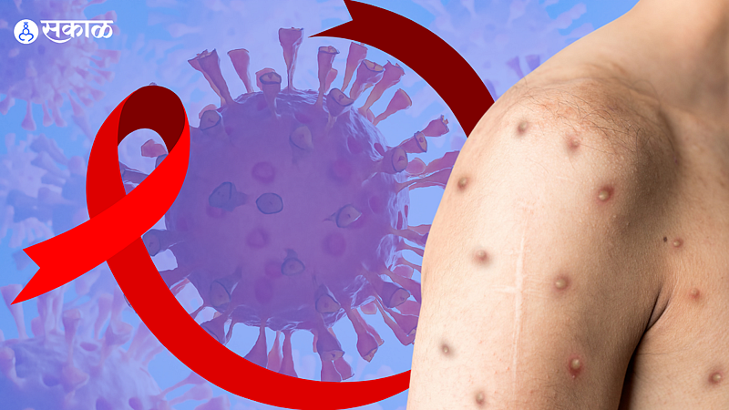 Monkeypox, Covid-19 and HIV