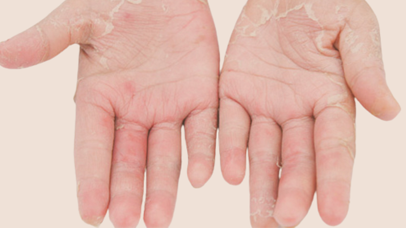 Monsoon infections
