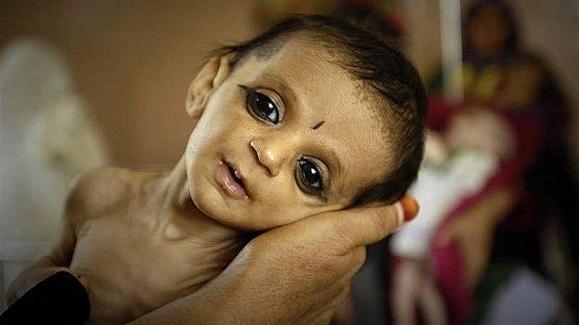 Dr Mansi Gore writes health child care Malnutrition to Well Nutrition