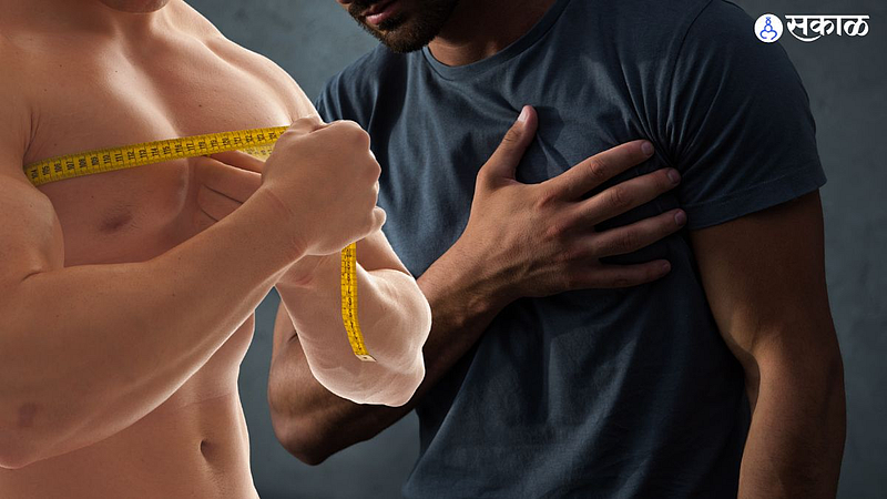 Gynecomastia