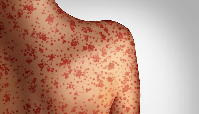 Measles Infection