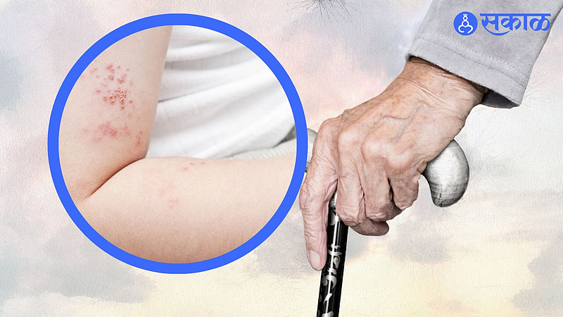 Shingles Rash