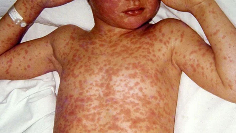 Measles Infection
