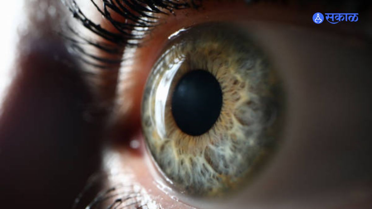 glaucoma