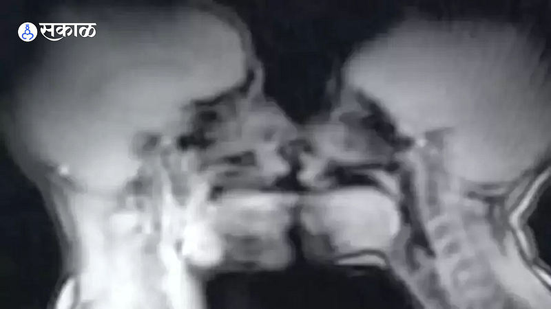 MRI