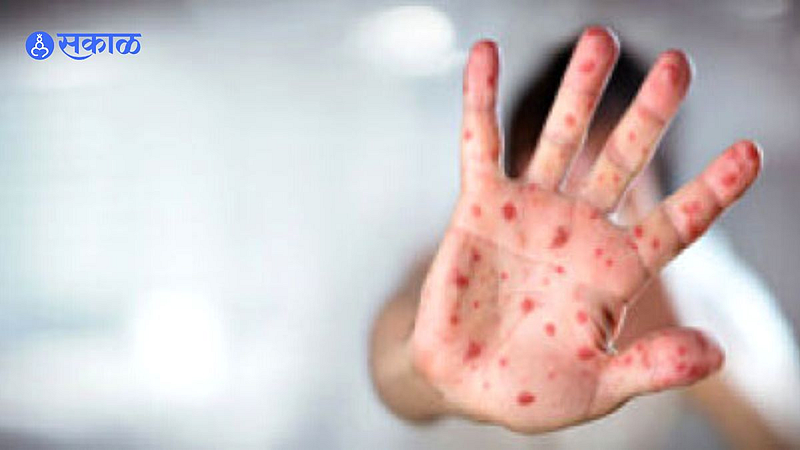 fifty measles infected people in akola health update doctor measles precautions