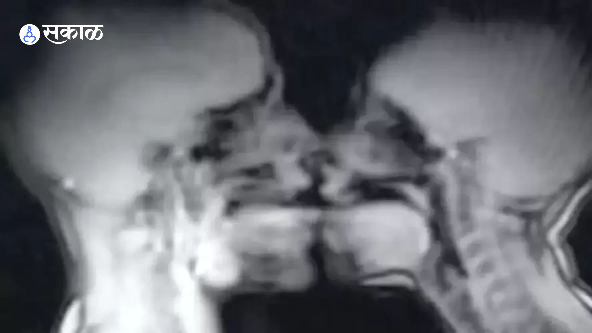 MRI