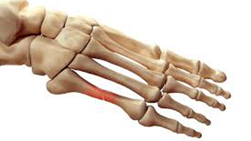 Bones