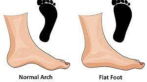If the legs are flat get treatment immediately Ignoring it will cause damage Nagpur news