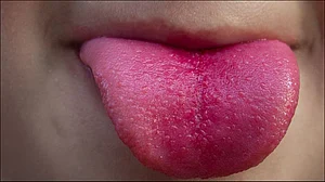 tongue cancer tongue cancer