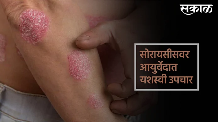 Ayurveda treatment is best for Psoriasis in India}