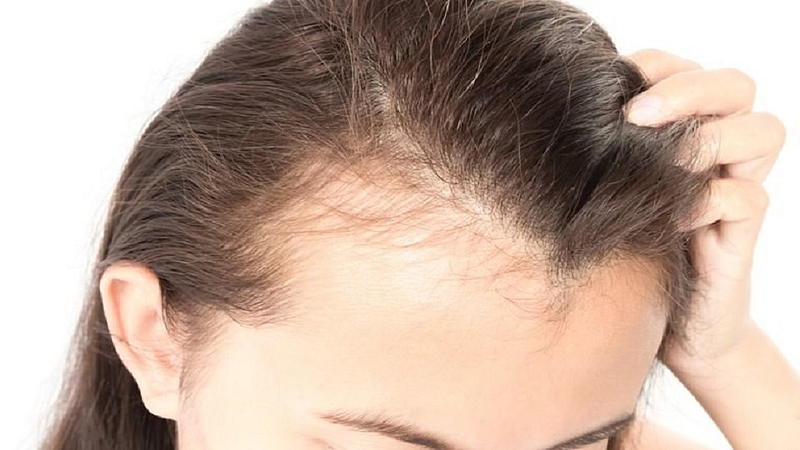 hair fall