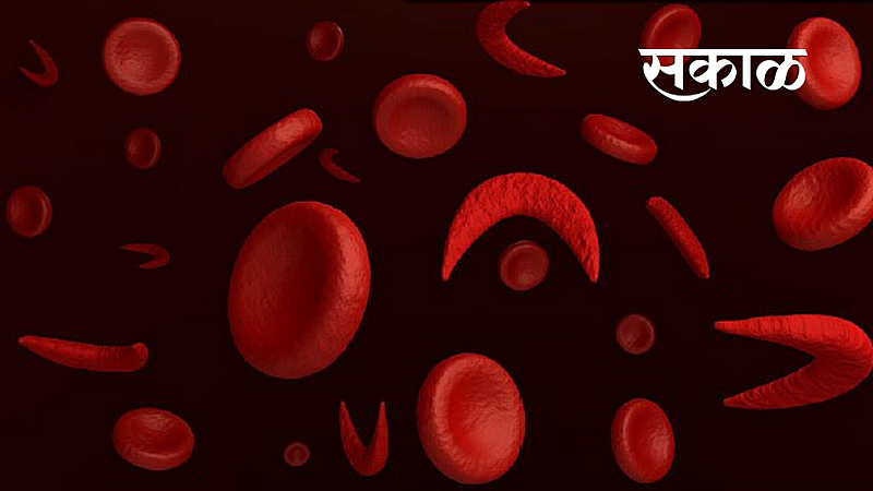 sickle cell patients