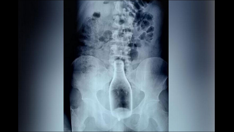 drunk man inserts glass bottle into body through anus, surgically removed in tn