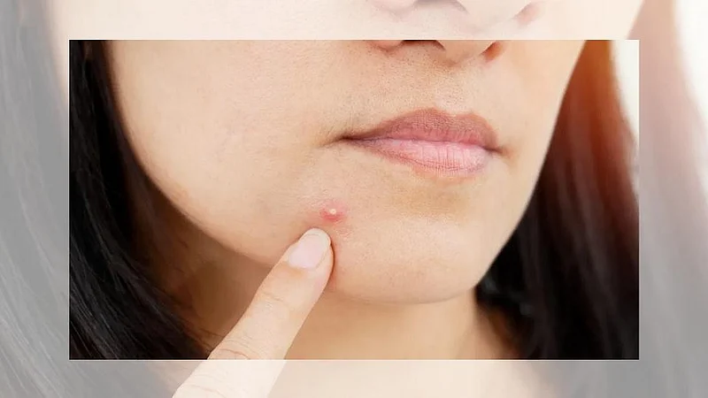 #PCOS : चेहऱ्यावर पुरळ येतंय? जाणून घ्या पीसीओएसची लक्षणं
