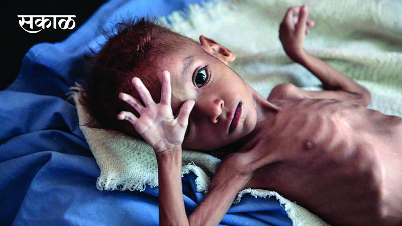 Malnutrition