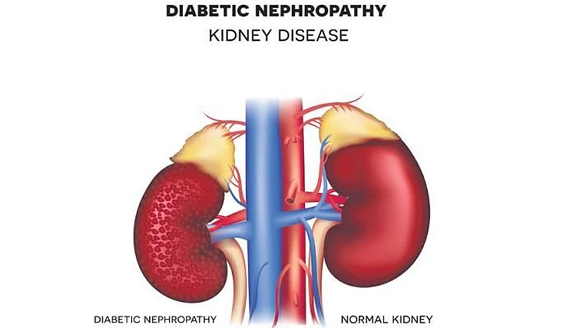 Now prediction the kidney failure of diabetes is possible