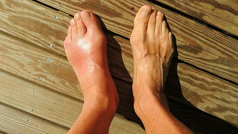 Gout