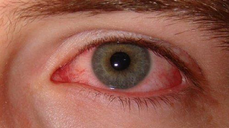 After corona Mucormycosis
