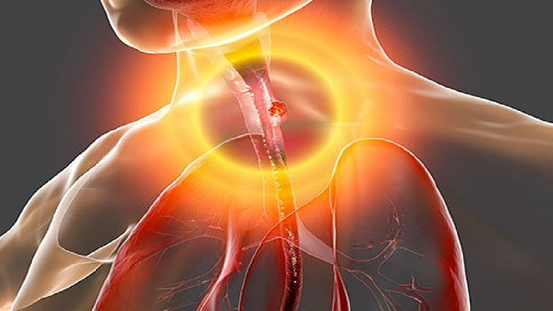 43 वर्षीय व्यक्तीच्या अन्ननलिकेतून काढला 8 सेंटिमीटरचा ट्यूमर