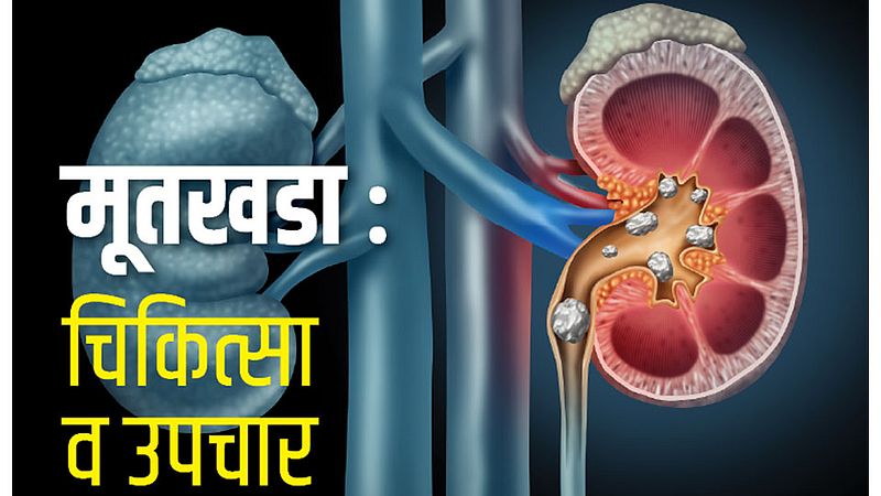 #FamilyDoctor मूतखडा - चिकित्सा व उपचार