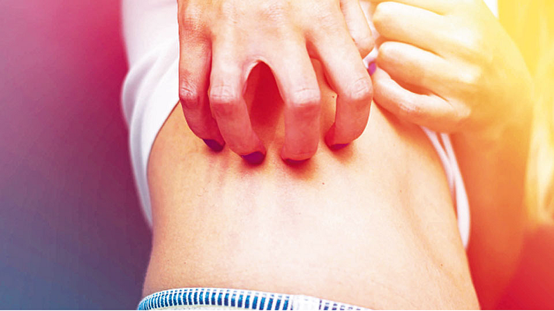 psoriasis