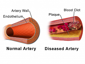Holistic healing: Reversing heart disease with food