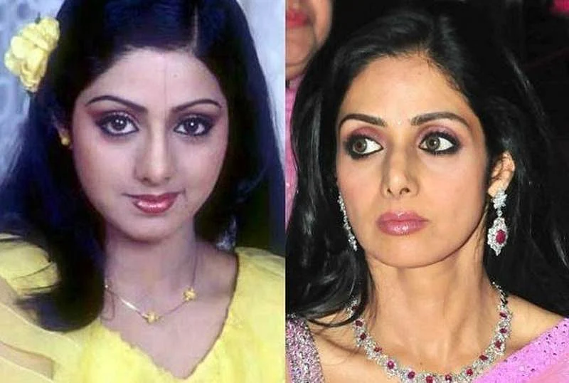 Anushka Sharma to Vaani Kapoor: 10 Bollywood heroines who went under the knife, and got it wrong
