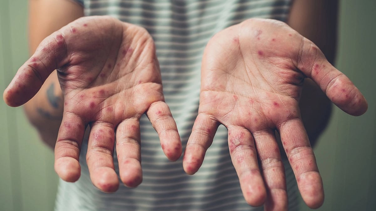 Navi Mumbai: Out of 21 measles cases this year, NMMC reported 14 alone in Oct-Nov - Vimarsana News