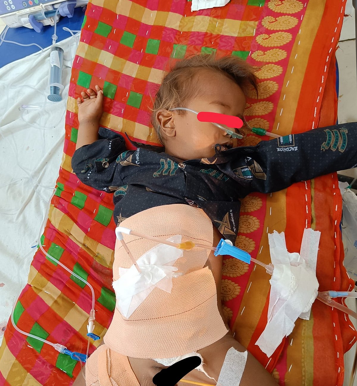 Indore: Doctors save five-month-old boy by performing peritoneal dialysis - Vimarsana News
