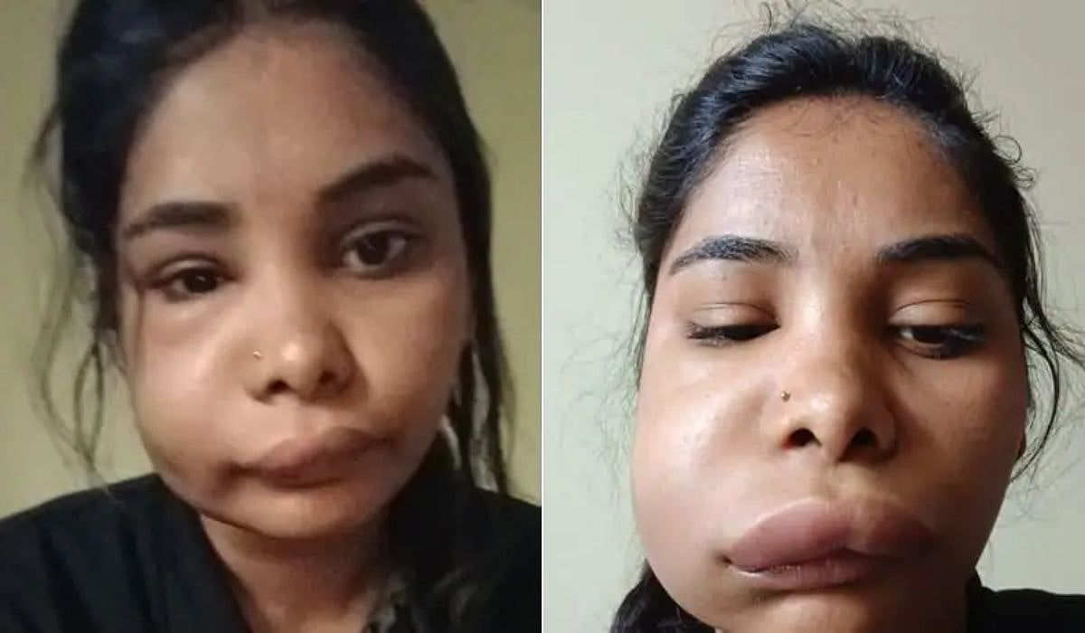 Kannada actress unrecognisable, face gets disfigured after root canal surgery goes wrong - Vimarsana News