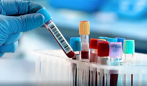Blood tests can predict which patients are likely to die - Vimarsana News