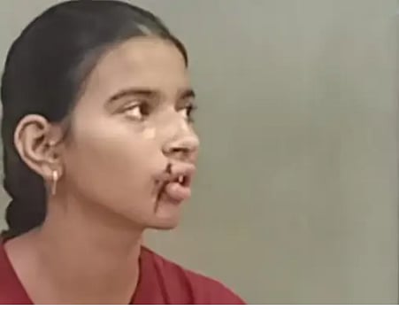 Bhopal: Teen shuttler injured in stone pelting - Vimarsana News