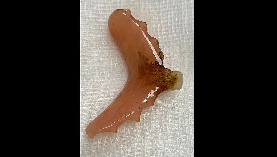 Panvel: Elderly man swallows denture, doctors remove it without surgery - Vimarsana News