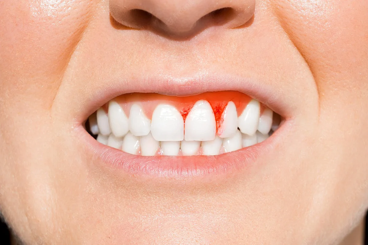 Bleeding gums