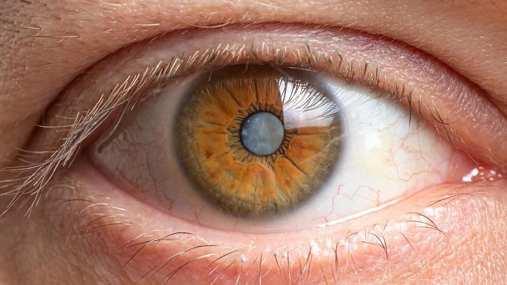Indore: 35 referred to hospital for cataract surgery - Vimarsana News