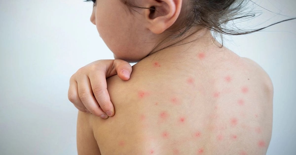 Mumbai News: Threat of Measles Outbreak Again Looms Large - Vimarsana News