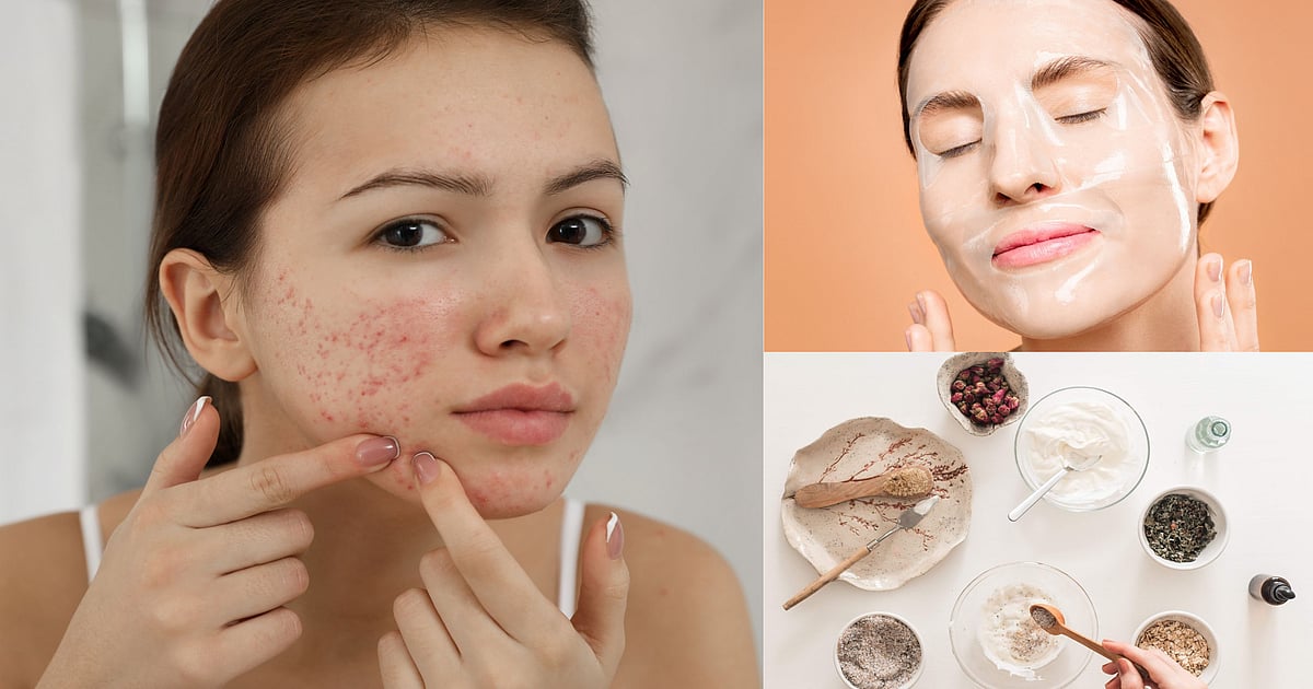 Scsr Mask Try these 4 DIY FACE MASKS to get rid of ACNE scars