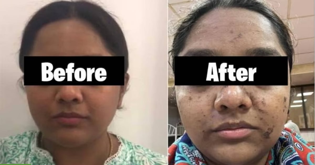Mumbai: Woman Suffers Burn Marks On Face After Paying ₹17,500 For Facial; FIR Against The Salon - Vimarsana News