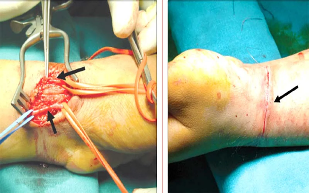 Patients of Kidney disease must take Fistula for Dialysis seriously