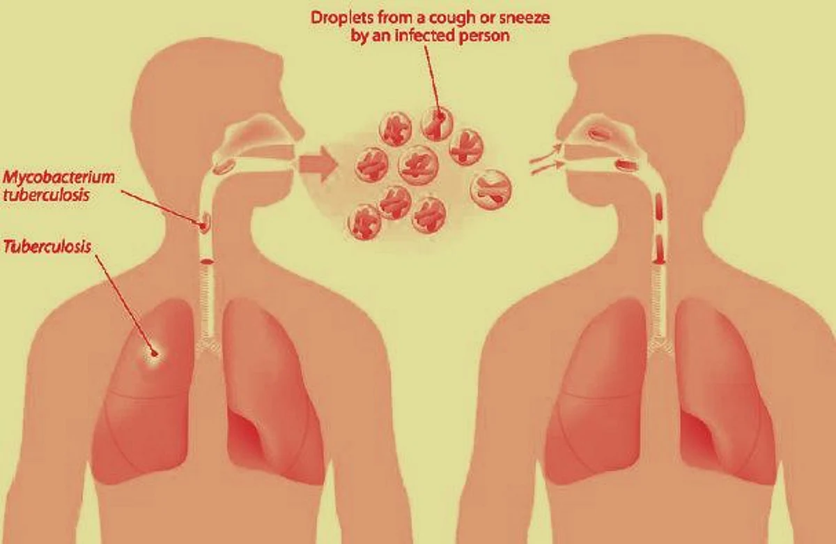 650 active Tuberculosis cases reported in Rajouri