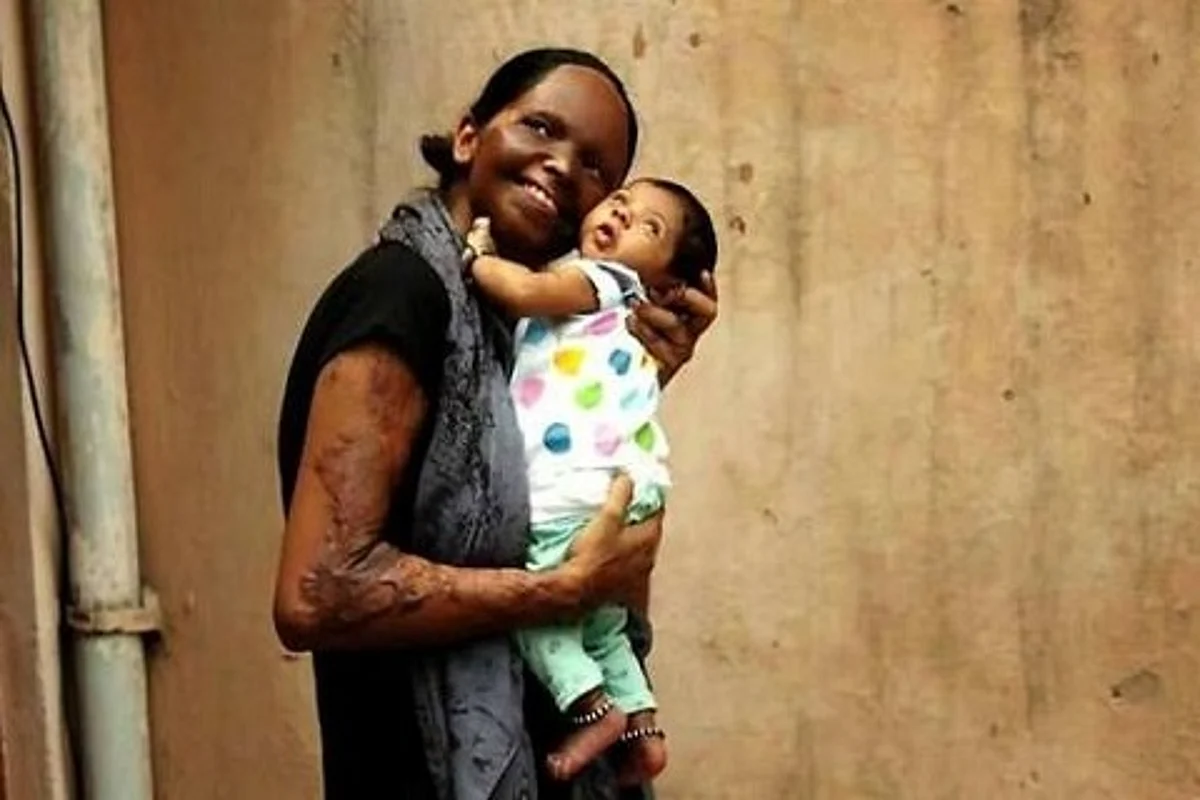 I lived on but many women can”t; so help me stop this: Acid attack survivor